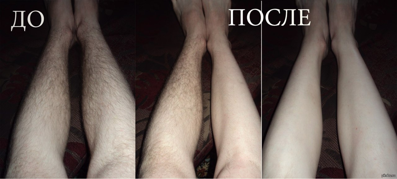 Что делать девушкам с волосатыми ногами